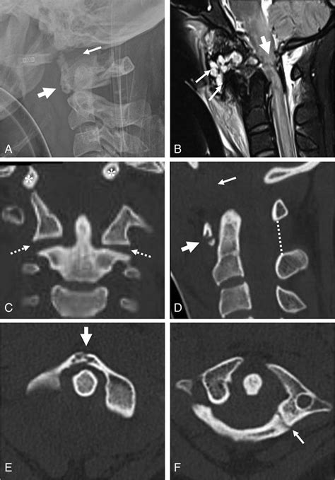 Lateral Radiograph Of The Cervical Spine Revealed Increased Soft Tissue