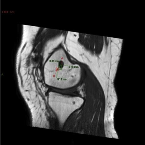 Magnetic Resonance Imaging Of The Operated Knee Showing The Measure