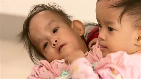 conjoined twins bhutanese girls separated after six hour surgery in