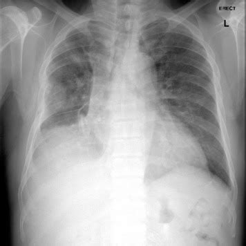 Increase in density in areas of ground glass and air trapping in lower lobes in patients with hypersensitivity pneumonitis. A 52-Year-Old Man Presenting With Chronic Cough and ...