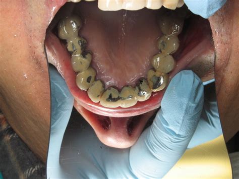 Dental Case Study 26 North Shore Restorative And Implant Dentistry