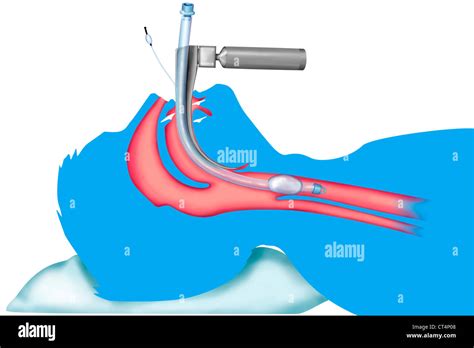 Tracheal Intubation Stock Photo Alamy