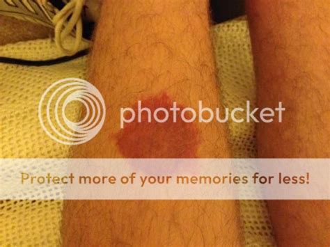 Help Have A Weird Circular Red Rash On Leg Skin Problems