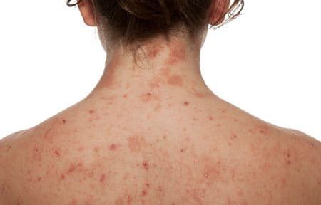 Dermatite At Pica No Corpo