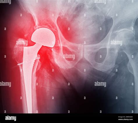An X Ray Reveals Both Hip Joints With Total Hip Arthroplasty