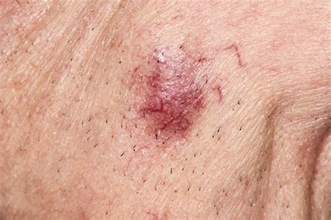 Merkel Cell Carcinoma Stage Is Strong Predictor Of Recurrence Risk
