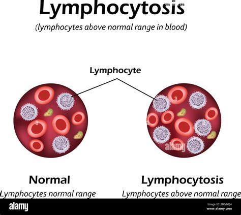Lymphocytes Above The Normal Range In The Blood Lymphocytosis Vector