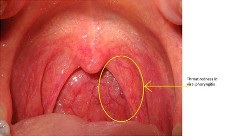 Hsv Tonsillitis About Tonsils Infection Slightly Causes Sore Throat