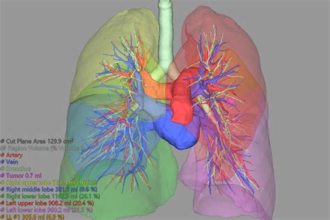 Lung Surgery Fujifilm Healthcare