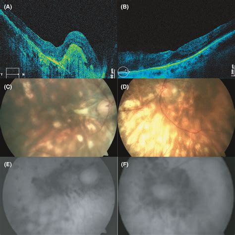 A Right Eye Last Visit Sd‐oct Soct Copernicus Hr Optopol