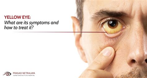 Yellow Eye What Are Its Symptoms And How To Treat It Prasad Netralaya