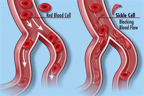 Sickle Cell Disease What Is It Symptoms And Treatment Top Doctors
