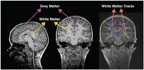 White Matter Microstructure In The Brain Is Influenced By Genetic Variants