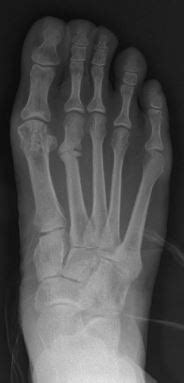 Wikizero - Stress fracture