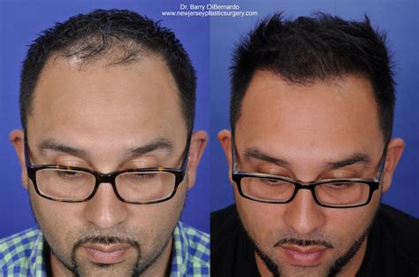 Smartgraft Hair Transplant Before And After Photos Patient 40 Houston