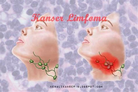 Terdapat beberapa rawatan untuk kanser tekak, tetapi kunci adalah untuk menangkapnya lebih awal. Apa Itu Kanser Limfoma (Lymphoma) | Kenali Kanser