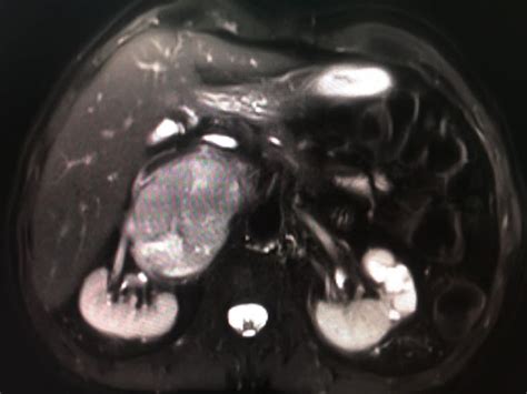 Retroperitoneal Paraganglioma Case