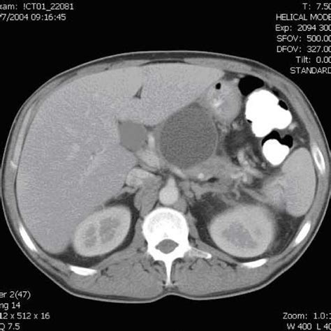 Ct Of The Abdomen Showing A Large 56 × 58 Cm Fluid Collection