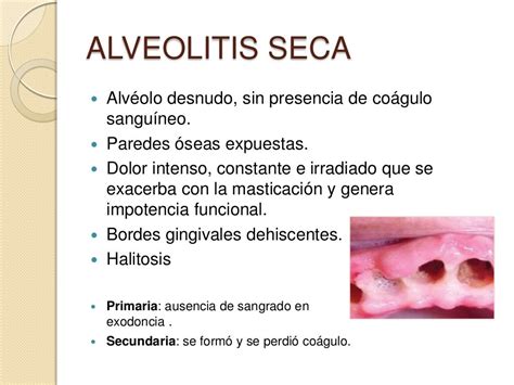 Alveolitis