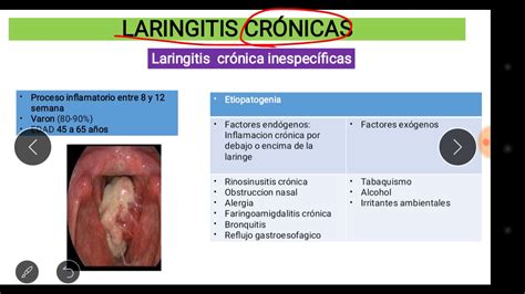 Laringitis Cronica Medicina Youtube