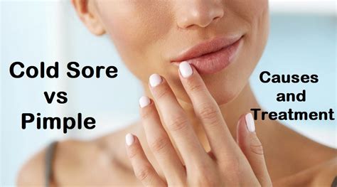 Cold Sore Vs Pimple Causes And Treatment Health Argue