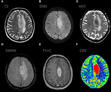 Frontiers Multiparametric Mr Imaging Features Of Primary Cns Lymphomas