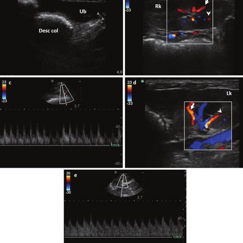 Ultrasound Imaging In B Mode Color And Spectral Doppler Of The