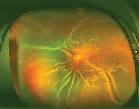 Rhegmatogenous Retinal Detachment Skv Consultant