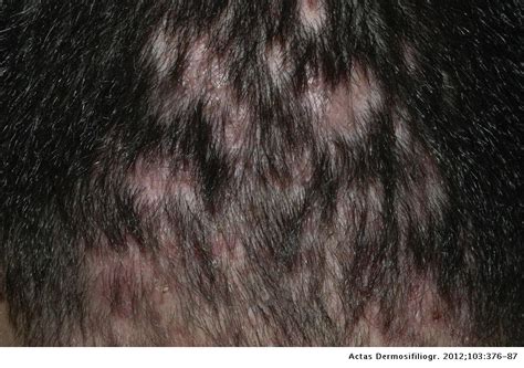 Scarring Alopecia Actas Dermo Sifiliográficas