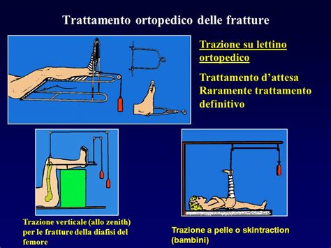 Valigetta trucco: Trazione femore