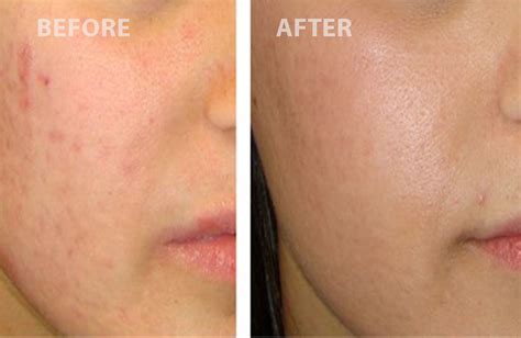 Laser Acne Treatment Can Fix Your Skin Issues Find Out