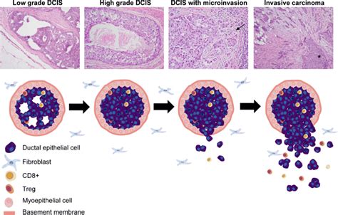 Progression Of Ductal Carcinoma In Situ To Invasive Carcinoma From A Download Scientific