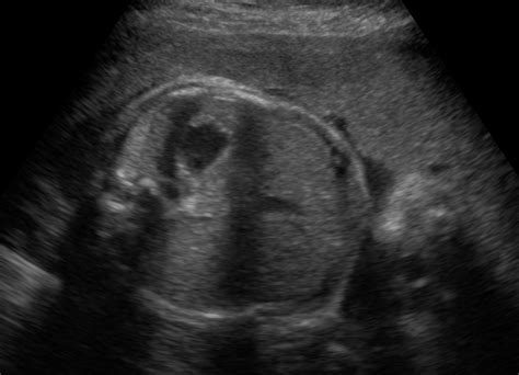 Ultrasound Images Of A The Fetal Head B The Fetal Femur C The