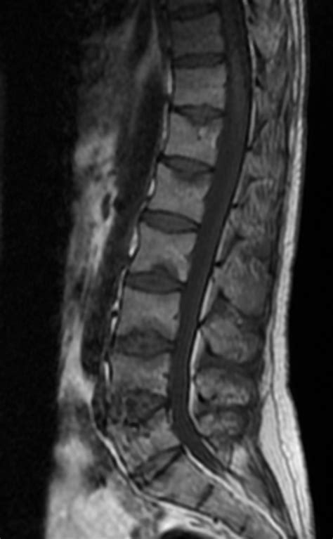 Ankylosing Spondylitis Andersson Lesion Image
