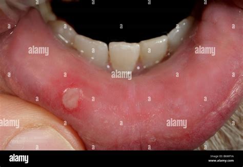 Aphthous Ulcer Canker Sore Hi Res Stock Photography And Images Alamy
