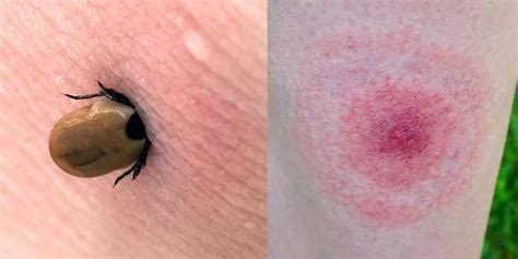 How To Identify Common Bug Bites And Treat Them Properly