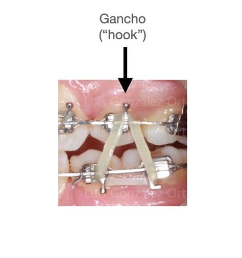 Lista 93 Foto Para Que Sirven Los Elasticos En Los Brackets Alta Definición Completa 2k 4k