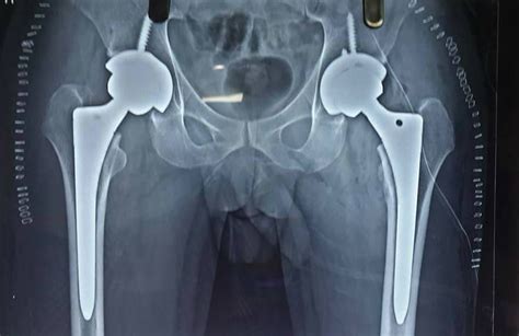 Bilateral Hip Avascular Necrosis Patient Operated Bilateral Total Hip