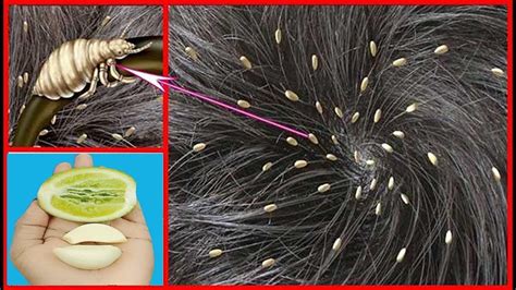 How To Get Rid Of Head Lice And Nits Permanently At Home Remove Head