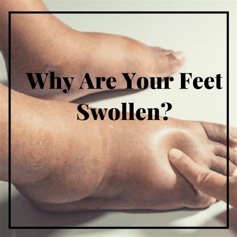 Why Are Your Feet Swollen Mark Forman Dpm Mba Fapwca Podiatrist