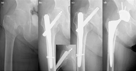 Figure 2 From Subcapital Femoral Neck Fracture After Fixation Of An