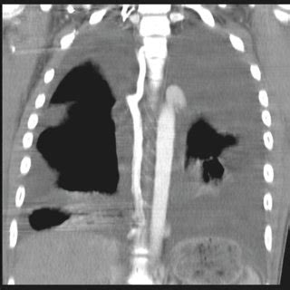 New users enjoy 60% off. CT of thorax with i.v. contrast Coronal plane. | Download ...