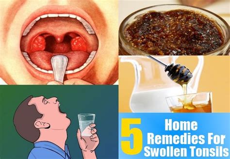 5 Home Remedies For Swollen Tonsils Remedies For Swollen Tonsils