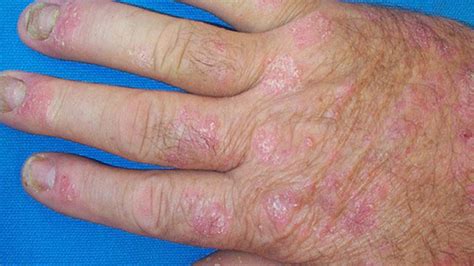 Pictures Of Psoriatic Arthritis Symptoms