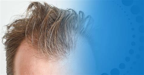 Ethnicity And Hair Loss Austin Hair Restoration Clinic