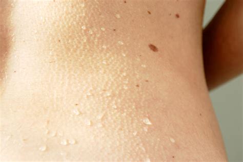 Small White Bumps On Skin Dorothee Padraig South West Skin Health Care