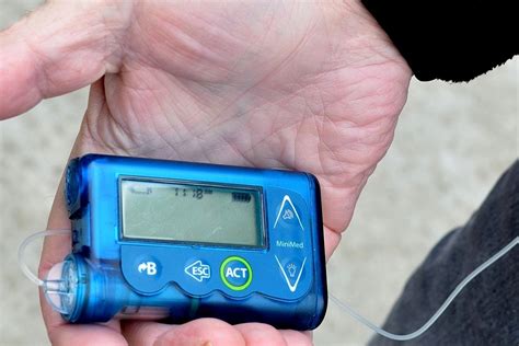 Healthcare Experts Give Nod To Diy Artificial Pancreas System For