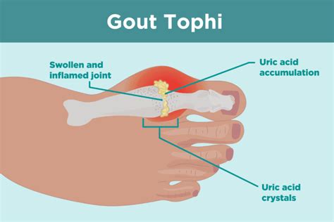 What Are Gout Tophi Causes Symptoms And Treatments