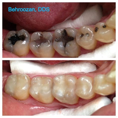 35 Cavities In Between Teeth Background Teeth Walls Collection For