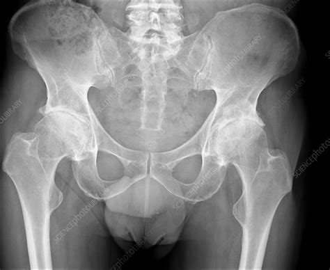Osteoarthritis Of The Hips X Ray Stock Image C016